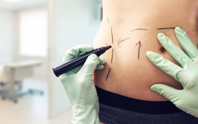 O que você precisa saber antes da cirurgia plástica