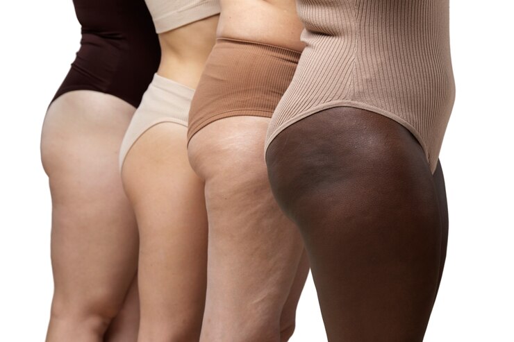 Lipedema – O Que é, Sintomas e Tratamento